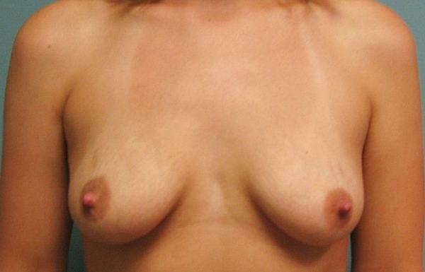 Before treatment: Breast Implants Surgery Menomonee Falls, WI Patient Transformation