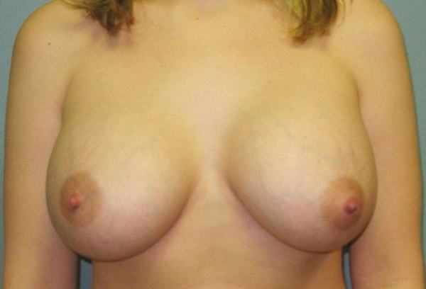 After treatment: Breast Implants Surgery Menomonee Falls, WI Patient Transformation