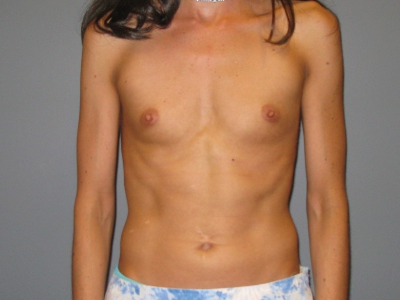Before treatment: Mommy Makeover Pewaukee