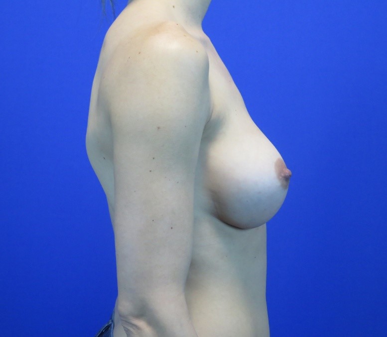 After treatment: Cosmetic Breast Surgery Sussex WI