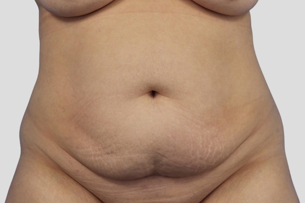 Before treatment: Abdominoplasty & Liposuction performed by Dr. Rowe - Front View