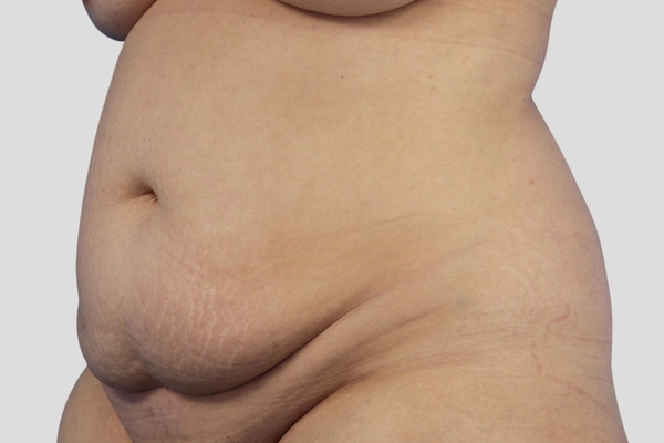 Before treatment: Abdominoplasty & Liposuction performed by Dr. Rowe - 45° Angle View