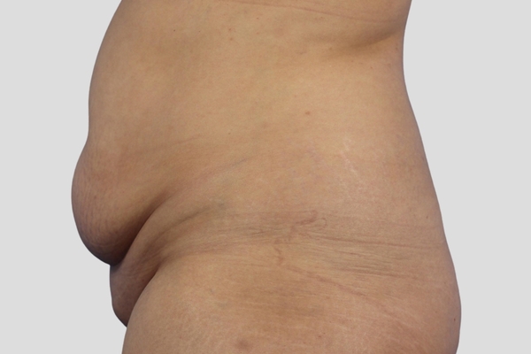 Before treatment: Abdominoplasty & Liposuction performed by Dr. Rowe - Side View