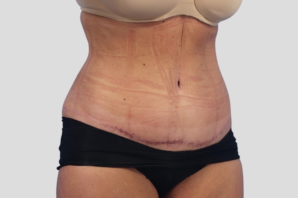 After treatment: Abdominoplasty & Liposuction performed by Dr. Rowe - 45° Angle View