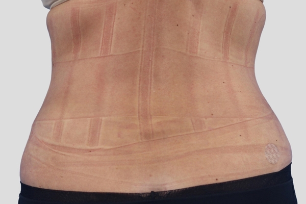 After treatment: Abdominoplasty & Liposuction performed by Dr. Rowe - Back View