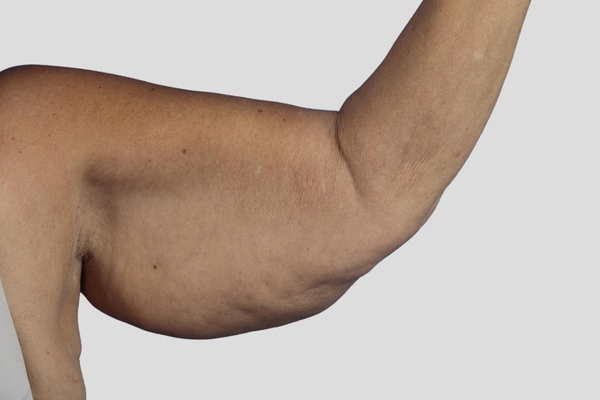 Before treatment: Brachioplasty performed by Dr. Rowe - Front View