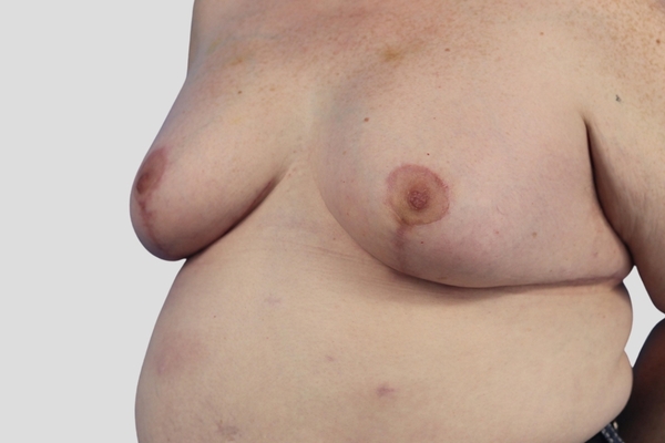 After treatment: Breast Augmentation & Excision of Lateral Chest Wall Excess performed by Dr. Rowe - 45° Angle View