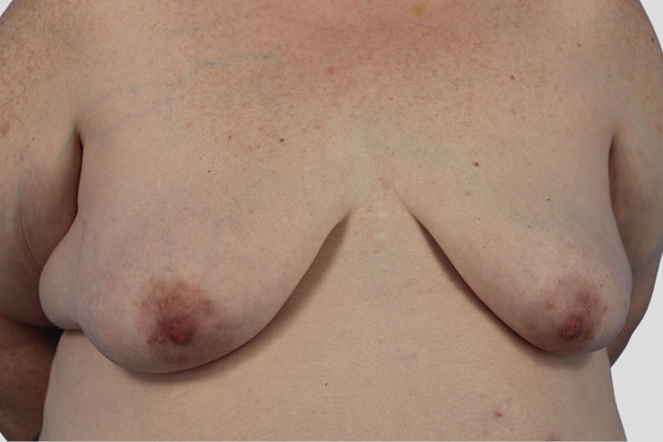 Before treatment: Breast Augmentation & Excision of Lateral Chest Wall Excess performed by Dr. Rowe - Front View