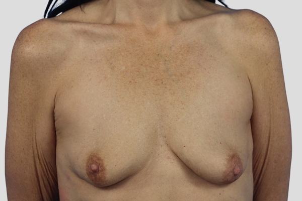 Before treatment: Breast Augmentation & Mastopexy performed by Dr. Rowe - Front View
