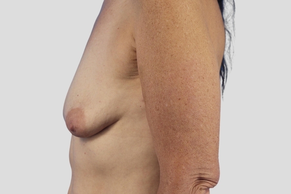 Before treatment: Breast Augmentation & Mastopexy performed by Dr. Rowe - Side View