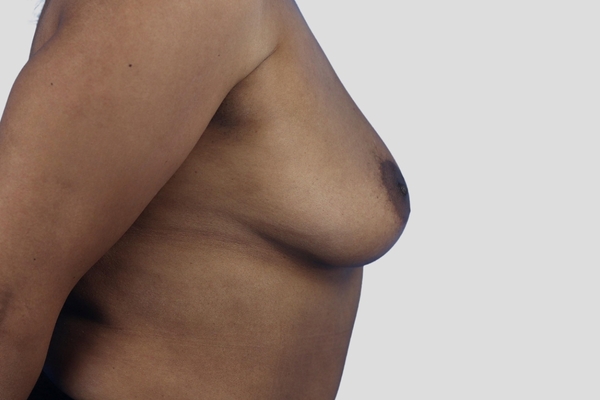 Before treatment: Breast Augmentation performed by Dr. Rowe - Side View