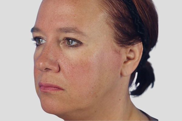 Before treatment: Endoscopic Brow Lift & Upper Blepharoplasty performed by Dr. Rowe - 45° Angle View