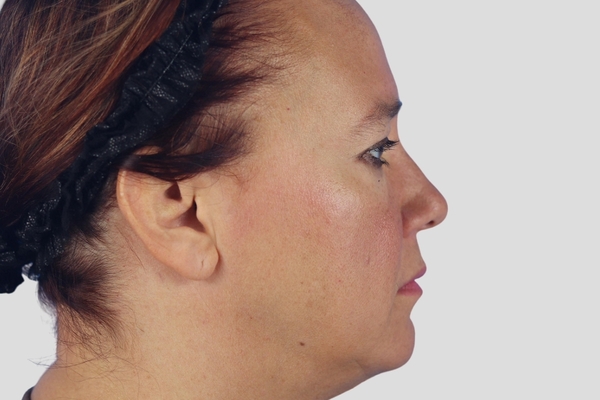 Before treatment: Endoscopic Brow Lift & Upper Blepharoplasty performed by Dr. Rowe - Side View