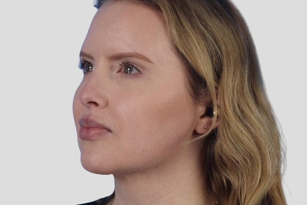 After treatment: Buccal Fat Reduction performed by Dr. Rowe - 45° Angle View