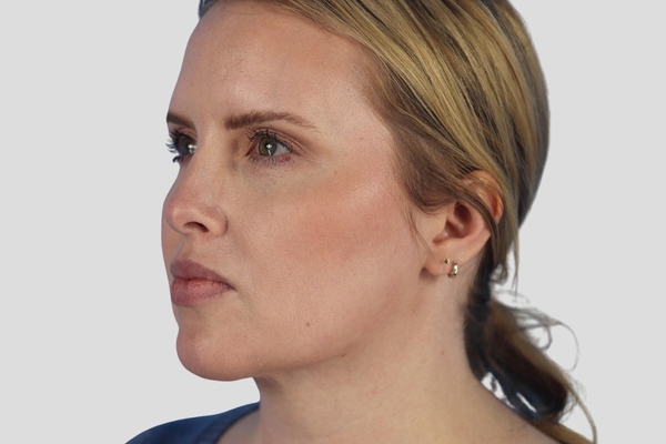 Before treatment: Buccal Fat Reduction performed by Dr. Rowe - 45° Angle View