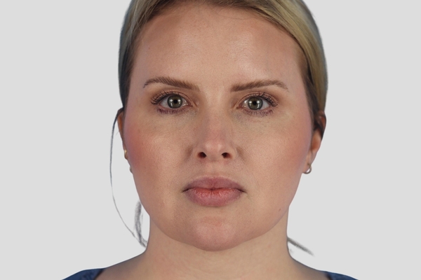 Before treatment: Buccal Fat Reduction performed by Dr. Rowe - Front View