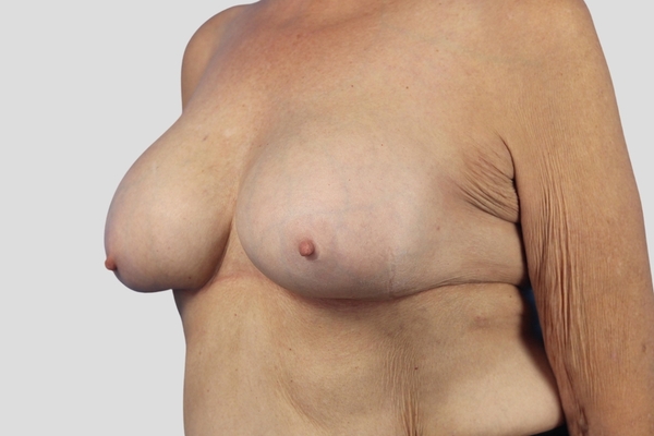 After treatment: Capsulectomy & Implant Exchange performed by Dr. Rowe - 45° Angle View