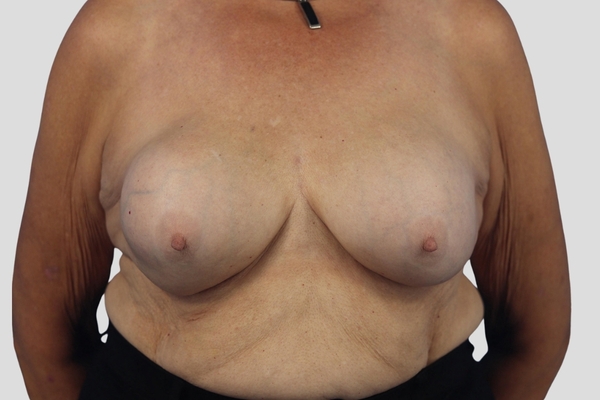Before treatment: Capsulectomy & Implant Exchange performed by Dr. Rowe - Front View