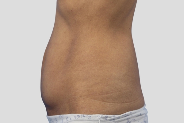 Before treatment: Extended Abdominoplasty performed by Dr. Rowe - Side View