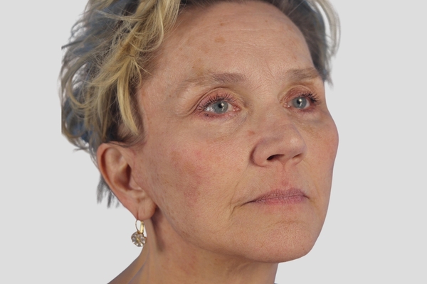 After treatment: Face Lift & Neck Lift performed by Dr. Rowe - 45° Angle View
