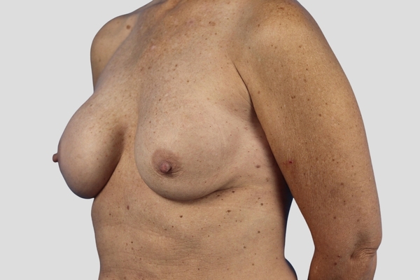 Before treatment: Implant Exchange performed by Dr. Rowe - 45° Angle View