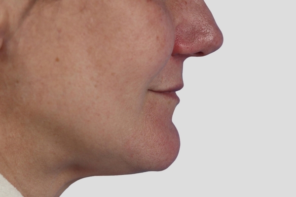 After treatment: Lip Lift performed by Dr. Rowe - Side View