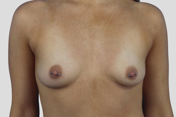 Before treatment: Subfascial Breast Augmentation performed by Dr. Rowe - Front View