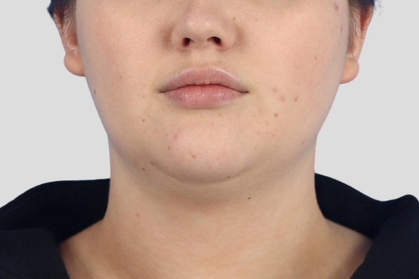 Before treatment: Submental Liposuction performed by Dr. Rowe - Front View