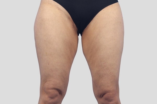 Before treatment: Thighplasty performed by Dr. Rowe - Front View
