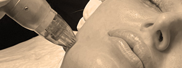 RF microneedling gallery
