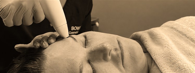 Venus Viva treatment applied to the side of a patient's face
