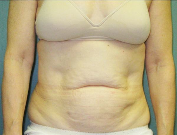 Before treatment: 