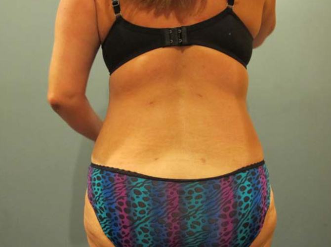After treatment: Arm Lift Liposuction Waukesha