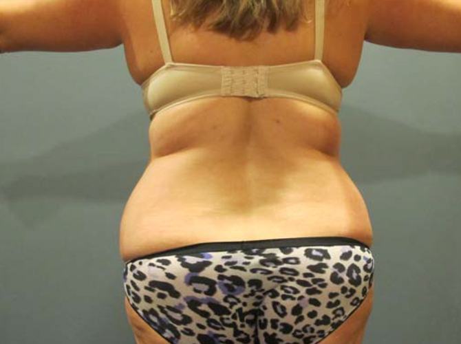 Before treatment: Arm Lift Liposuction Waukesha
