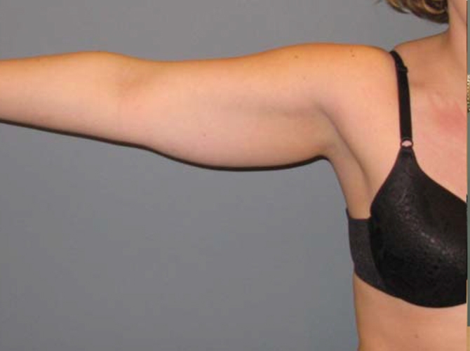 After treatment: Arm Lift Liposuction Milwaukee