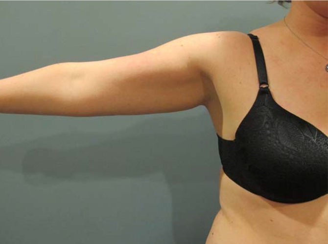 Before treatment: Arm Lift Liposuction Milwaukee