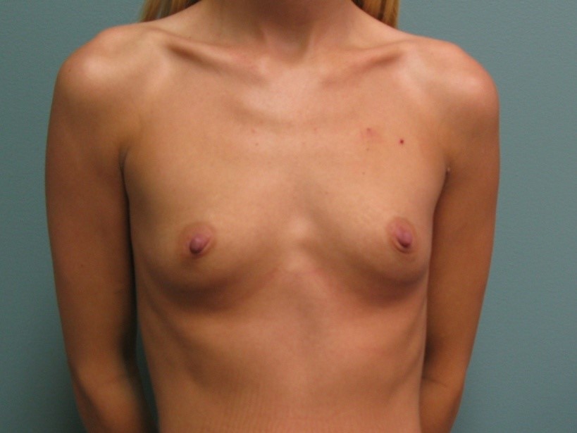 Before treatment: Mommy Makeover Breast Surgery Oak Creek