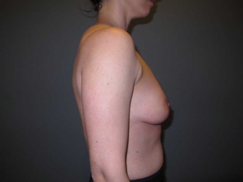 Before treatment: Mommy Makeover Manitowoc