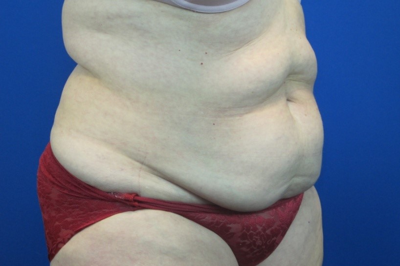 Before treatment: Mommy Makeover Hartland