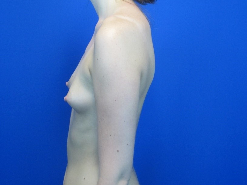 Before treatment: Mommy Makeover Breast Implants Brookfield