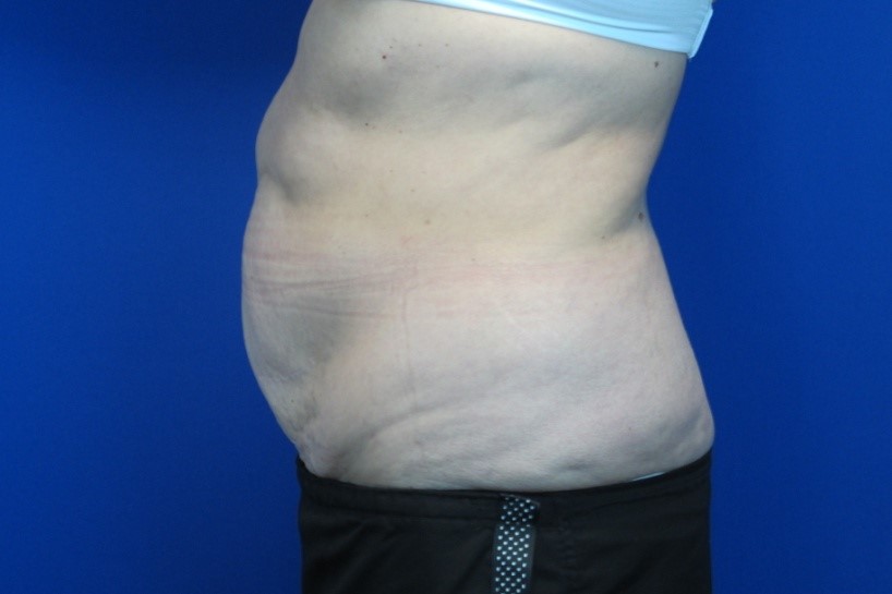 Before treatment: Kenosha Tummy Tuck Surgery