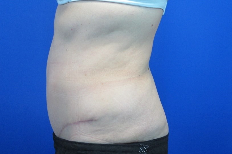 After treatment: Kenosha Tummy Tuck Surgery