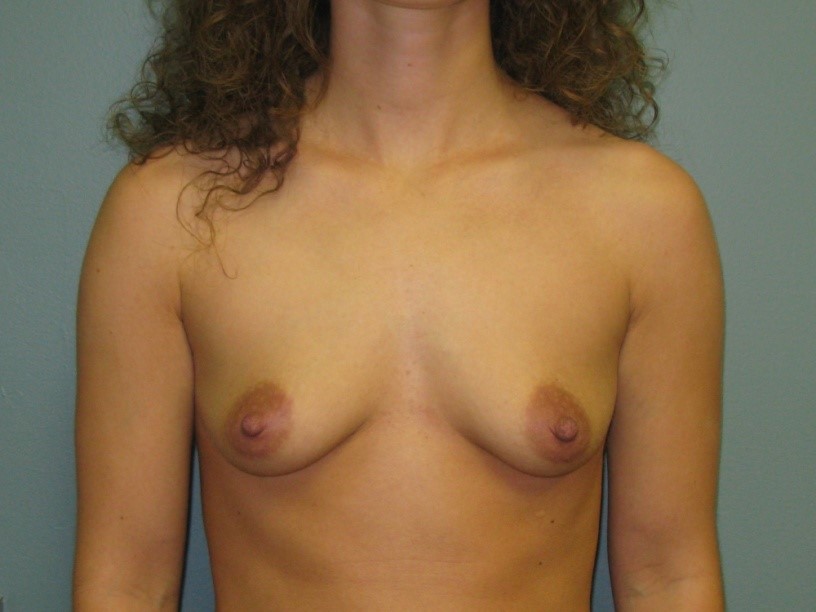 Before treatment: Mommy Makeover Menomonee Falls
