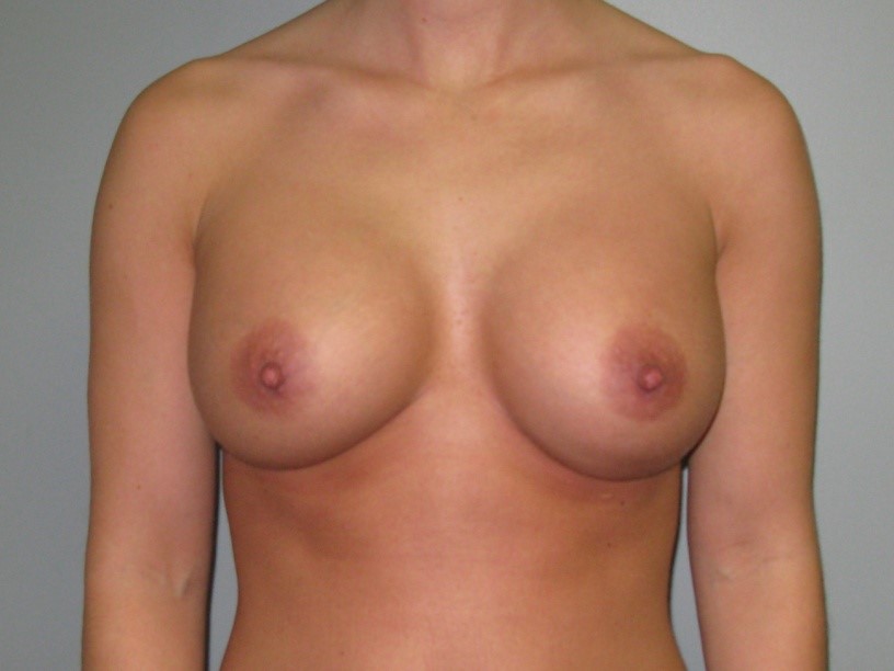 After treatment: Mommy Makeover Menomonee Falls