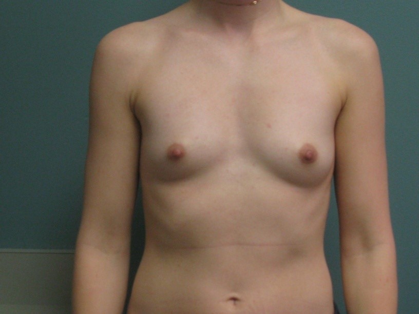 Before treatment: Milwaukee Mommy Makeover
