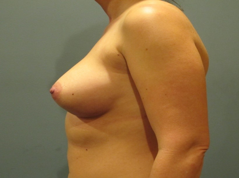 After treatment: New Berlin Mommy Makeover