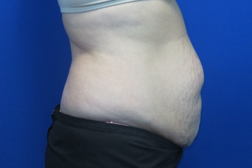 Before treatment: Pewaukee Mommy Makeover