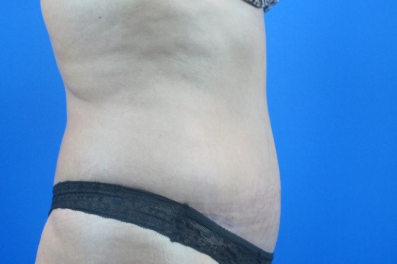 After treatment: Pewaukee Mommy Makeover