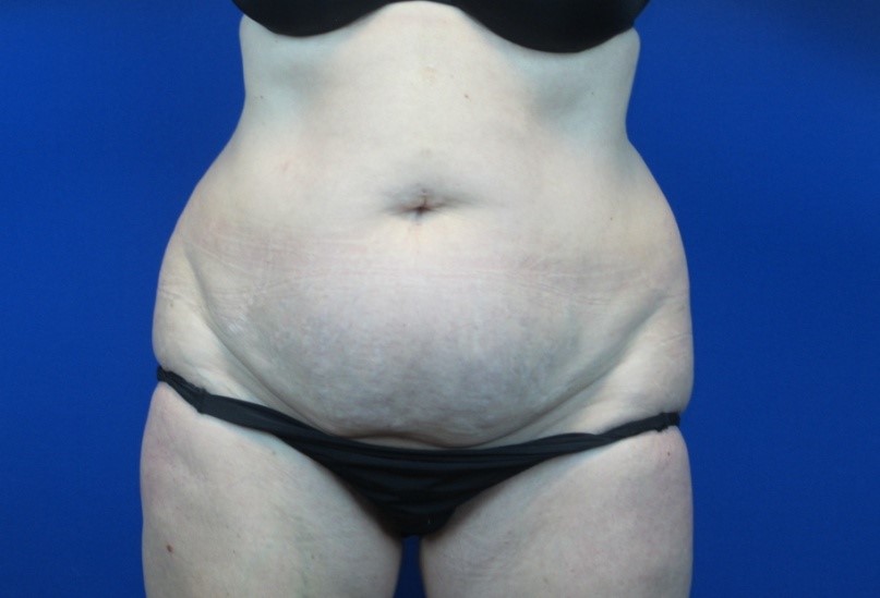 Before treatment: Mommy Makeover Racine