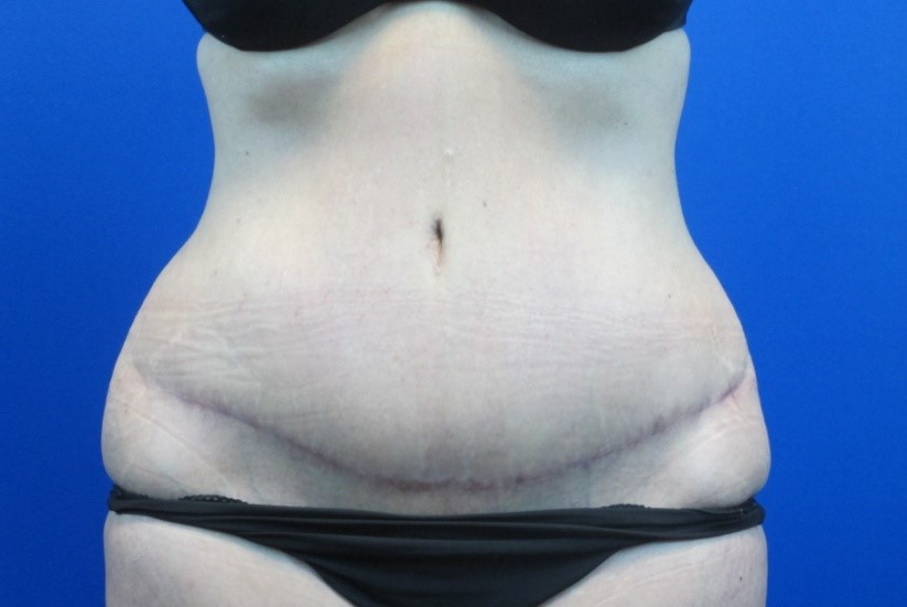 After treatment: Mommy Makeover Racine